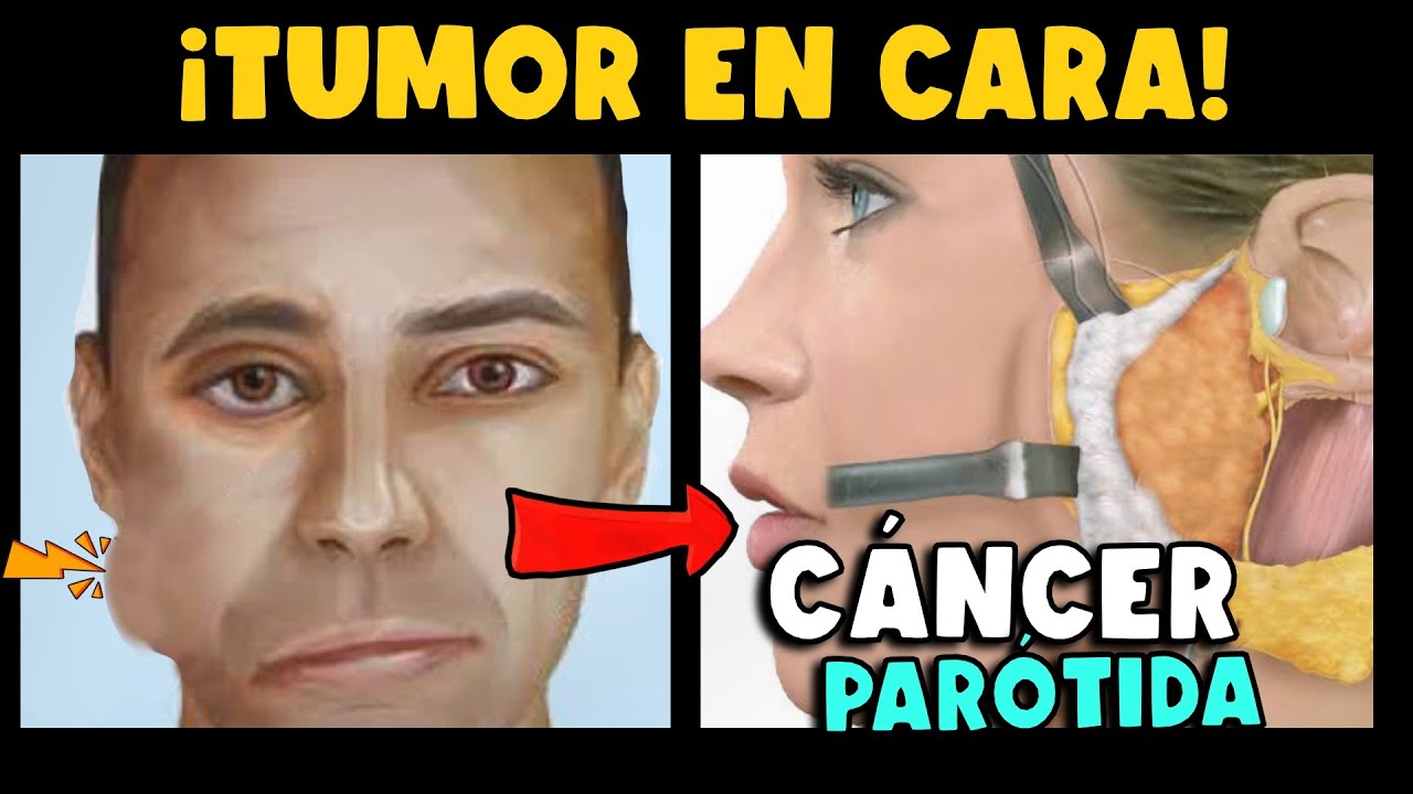 ¡CUIDADO! ¿TUMOR EN CARA? ¿ASIMETRÍA FACIAL? ¿QUÉ ES EL CÁNCER DE PARÓTIDA?