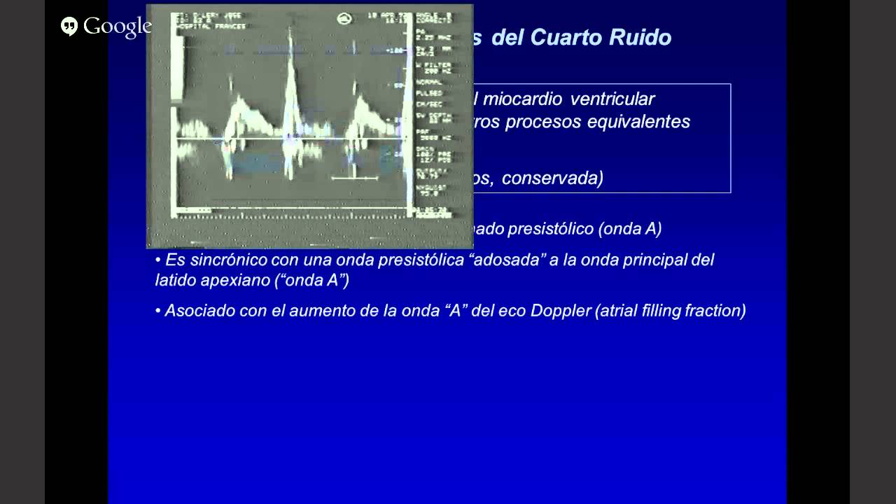 Auscultacion cardica: tercer y cuarto ruidos