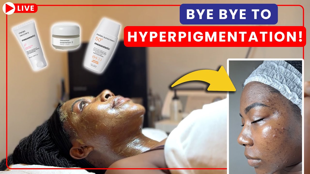 The ULTIMATE Peel For Dark Skin: My Cosmelan Experience Treating Dark Spots & Hyperpigmentation