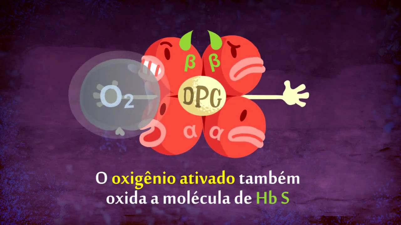 Anemia Falciforme