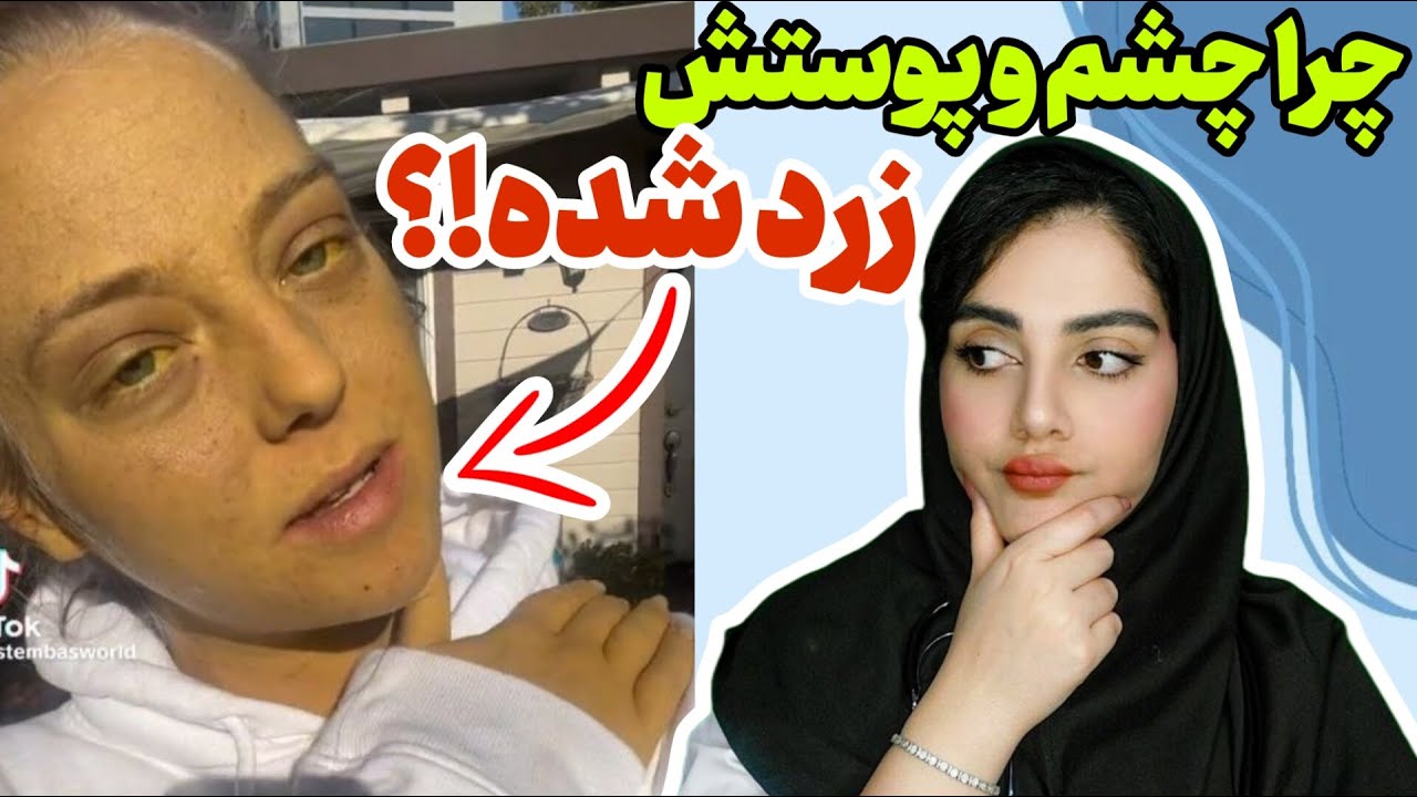 زردی چیست؟ | علائم و نشانه های یرقان در بزرگسالی| رویکرد بالینی به زردی