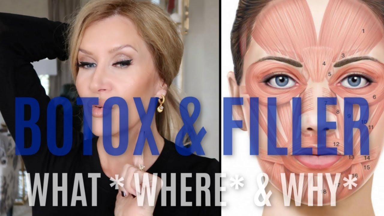 Filler & Botox~What I Have and Why