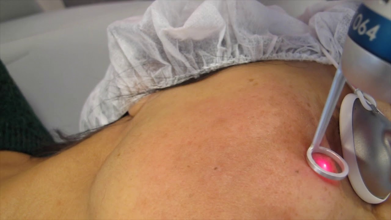 Picoway Resolve (532nm/1064nm)  against Melasma