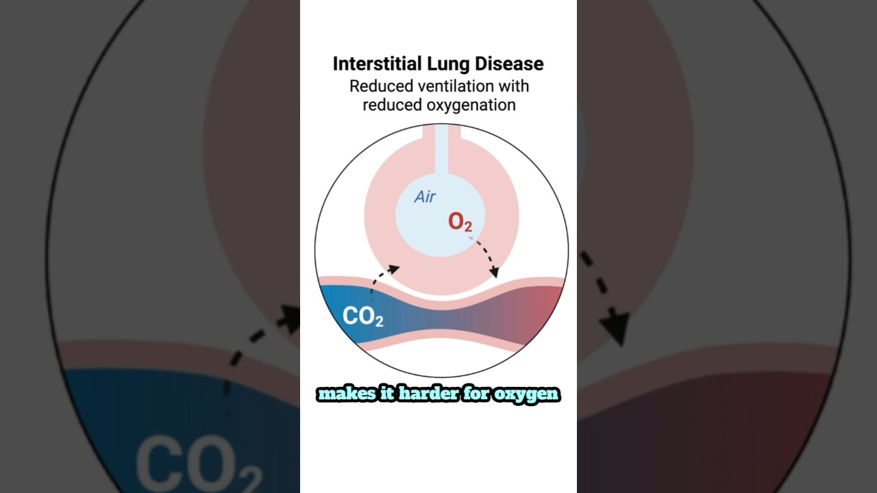Interstitial Lung Disease (ILD) Explained #interstitiallungdisease #lungs #scienceexplained