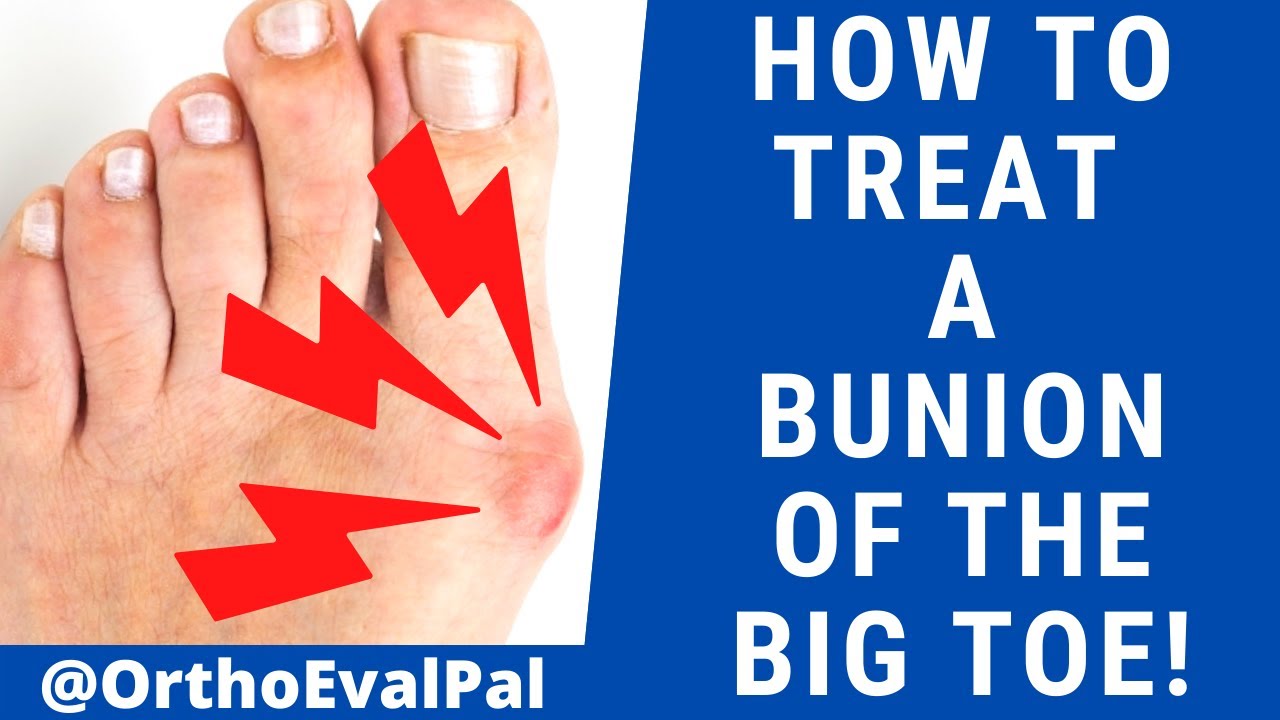 How to Treat a Bunion of the Big Toe!