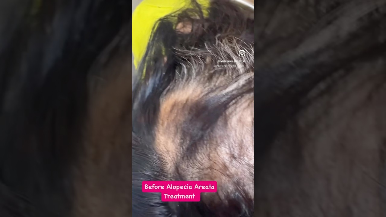 Alopecia Areata Recovery: New Hair Growth in 20 Days! |White to Black Hair Transformation #alopecia