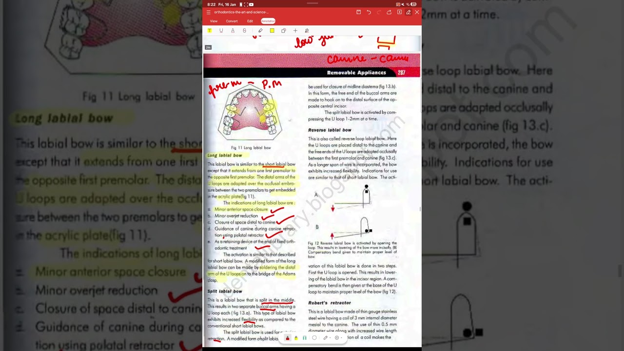Removable Orthodontic Appliances | Active Components Explained (For Dental Students)