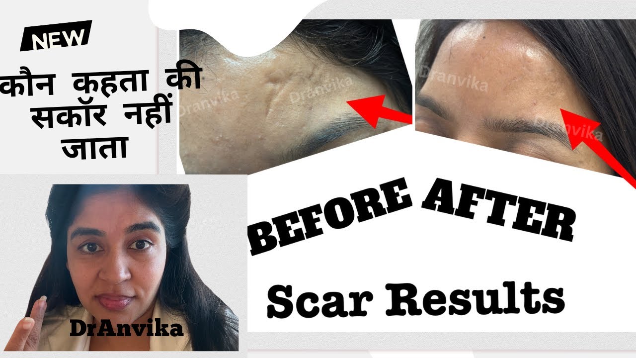 Injury scar on face | चोट के निशान का इलाज | best clinic for scars | स्कार को कैसे ठीक करें ? 
