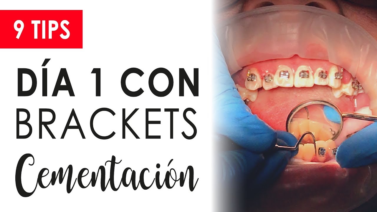 PRIMER DÍA CON BRACKETS, CEMENTACIÓN | QUÉ HACER Y QUÉ NO HACER