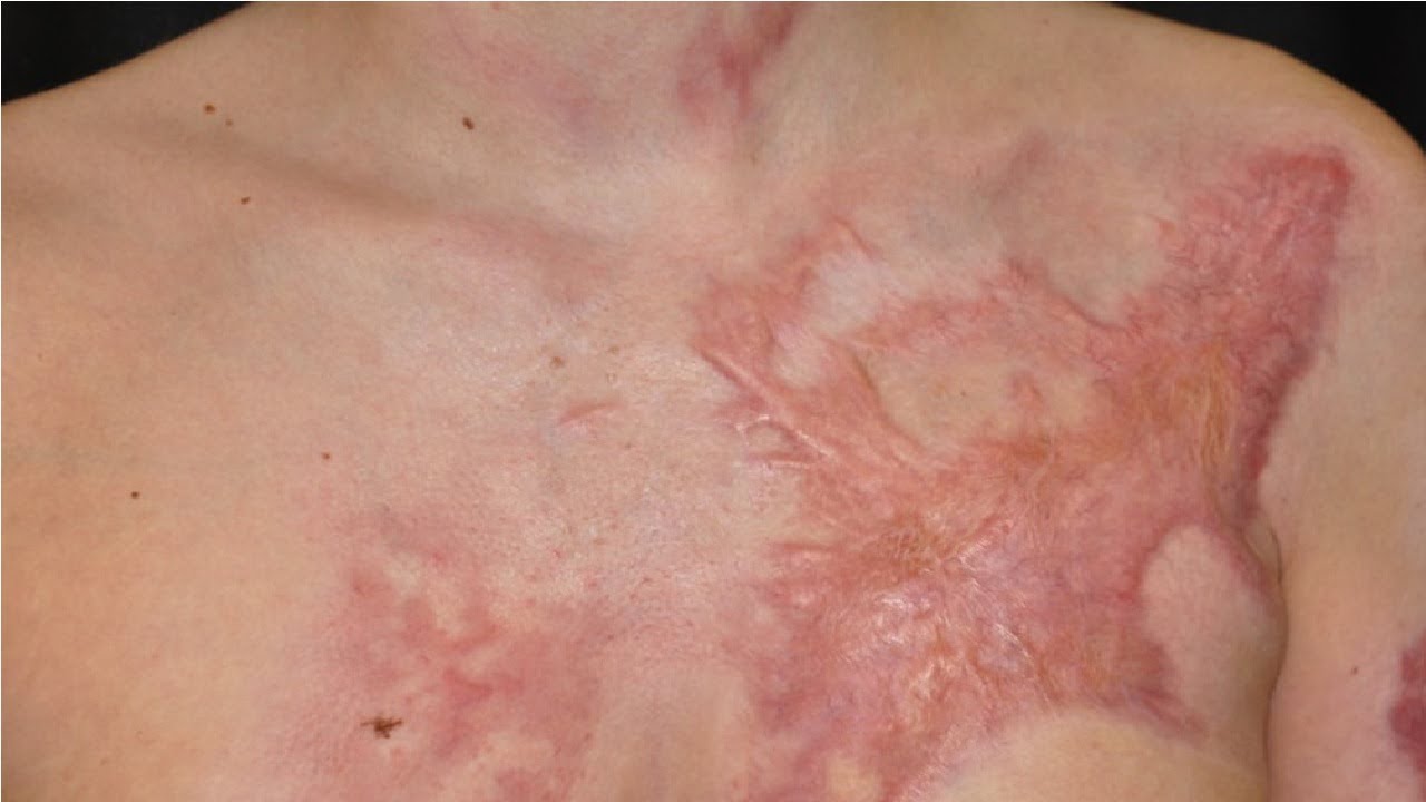 how to get rid of burn scars on legs