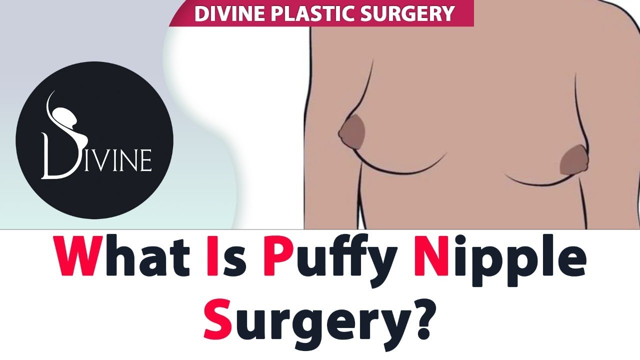 What Is Puffy Nipple Surgery? | Gynecomastia Surgery