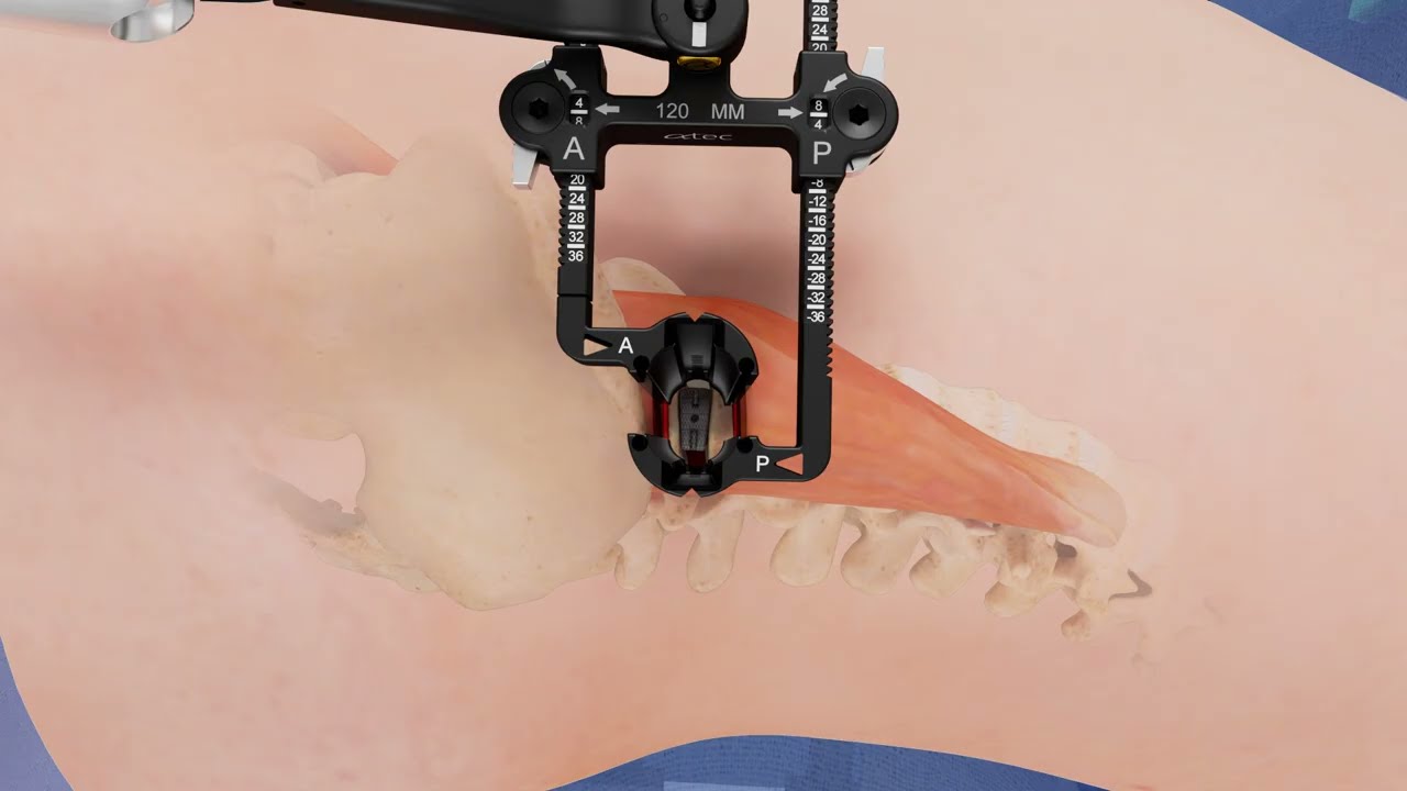 ATEC Lateral Positioner – Precision Surgical Support Visualization by Pulse 3D Media