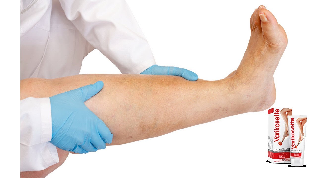 Varikosette - Evita la aparici&oacute;n de v&aacute;rices