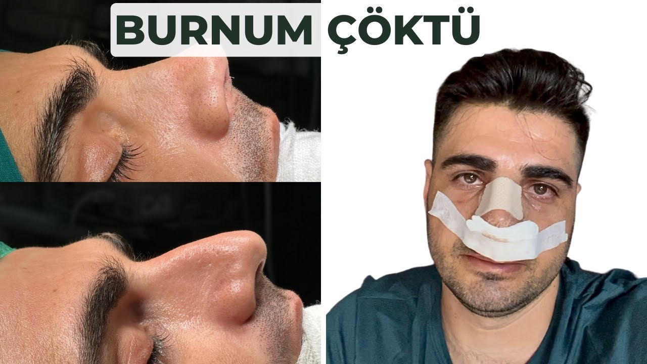 BURUN AMELİYATI SÜRECİM! | 6 AYLIK VLOG