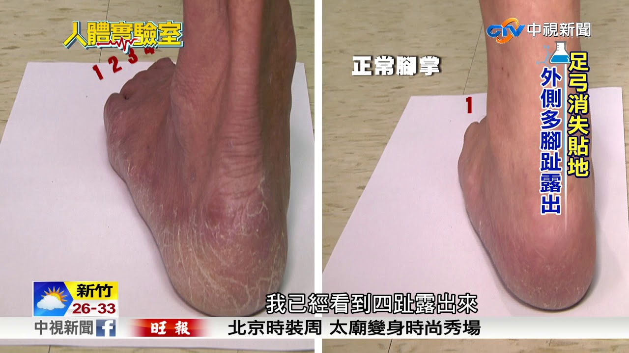 人體實驗室 扁平足拇指外翻怎麼辦│中視新聞 20170925