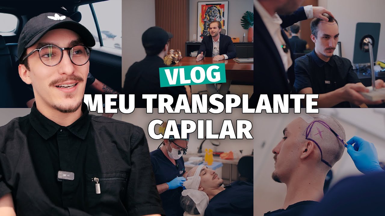 Acompanhe meu TRANSPLANTE CAPILAR no GRUPO CAPILAR - VLOG