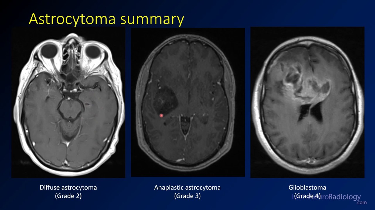 Imaging brain tumors - 2 - Astrocytomas