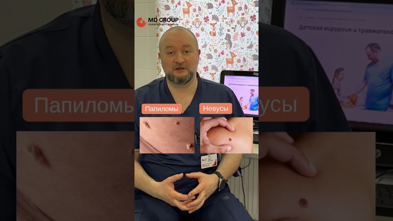 Удаляем бородавки детям #shorts #бородавки #папилломы #папиллома #хирург #детскоездоровье