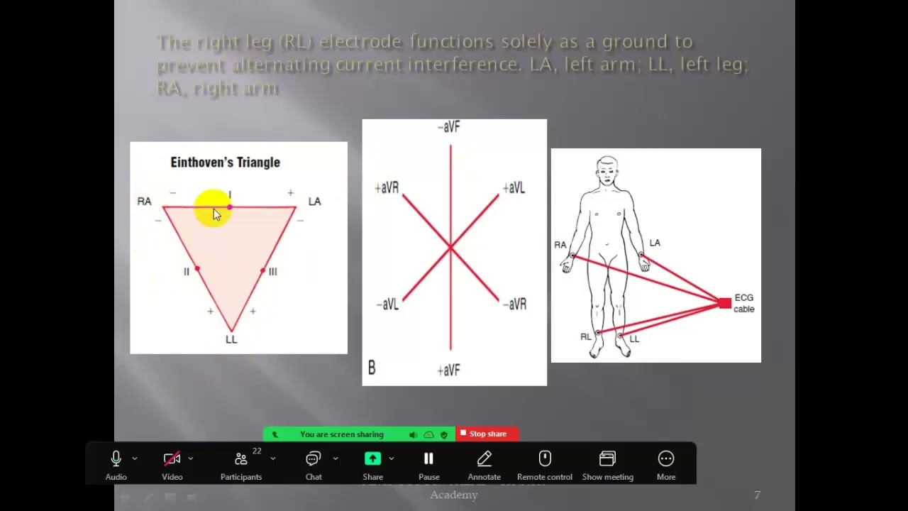 MRCP Part 1 Cardiology: أساسيات ECG ومفاتيح أصعب الـ Arrhythmias وحالات الـ Emergency