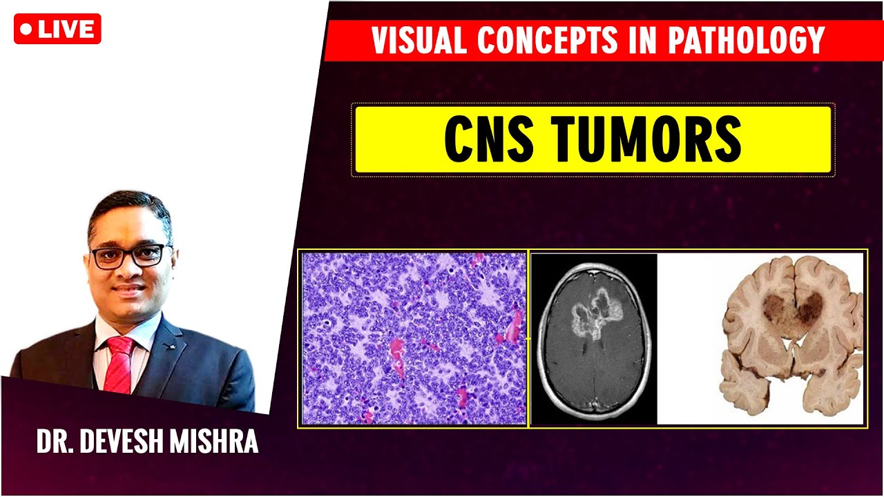 Visual concepts in Pathology:CNS Tumors by Dr Devesh Mishra