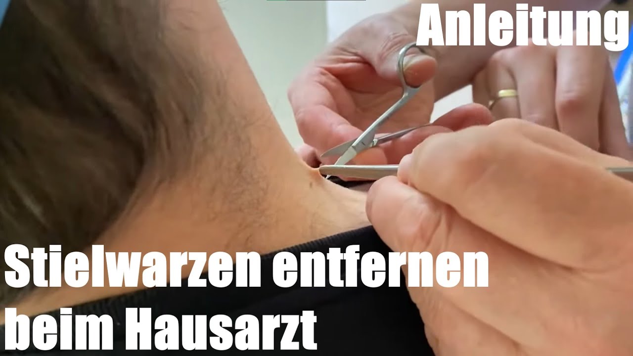 Fibrome (Stielwarze) schnell und schmerzfrei entfernen mit Schere beim Hausarzt