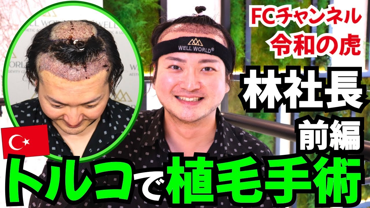 【お宝映像1】令和の虎 林社長のトルコ植毛に密着 前編【自毛植毛｜フランチャイズチャンネル】