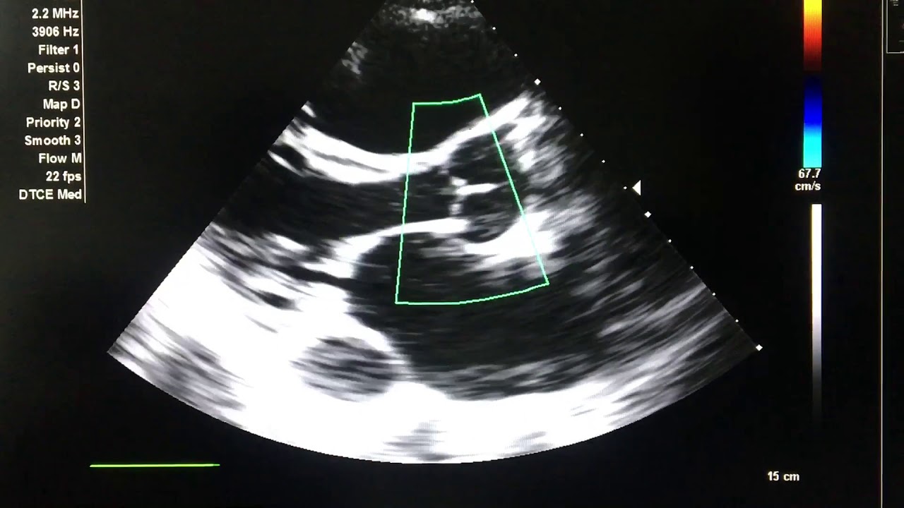 Post ASD Closure ECHO