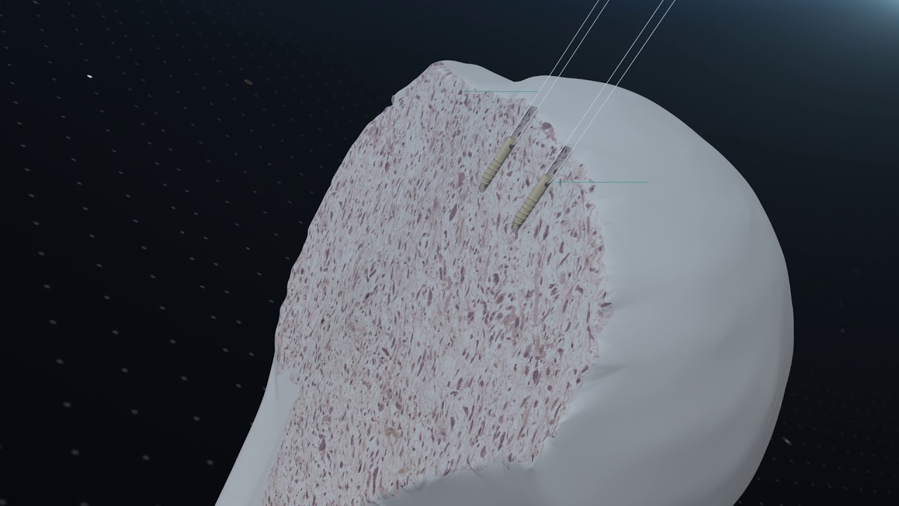 SIRONIX ALL SUTURE LOOP ANCHOR