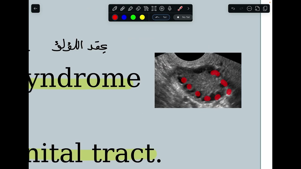 Gynecology- secondary amenorrhea 