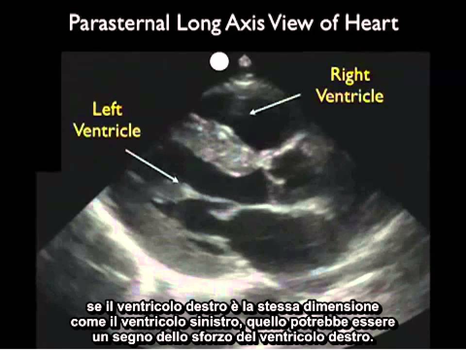 Video procedurale: Ecografia cardiaca - Asse lungo parasternale - Parte 1