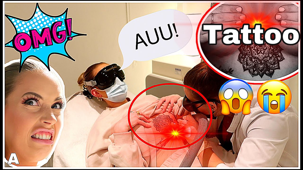 Fjerner TATTOO med LASER