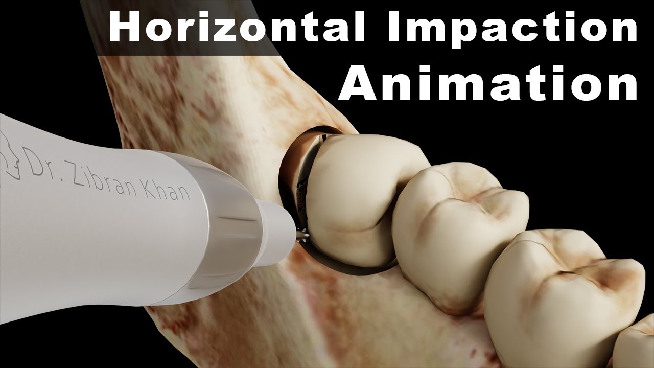 Innovative 3D Animation: Horizontal Impacted Mandibular Third Molar Extraction