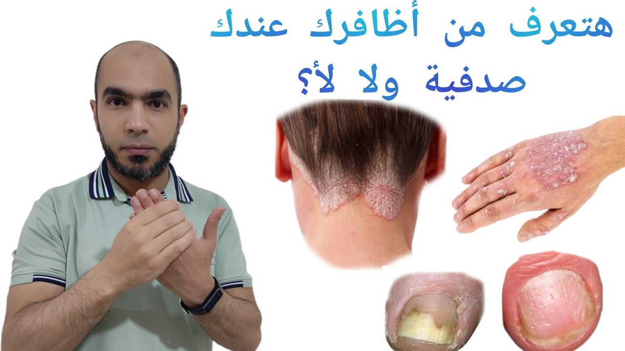 هام جدا وإبحث عن علامات مرض الصدفية علي الأظافر د يوسف الملاحي @Dr_youssef
