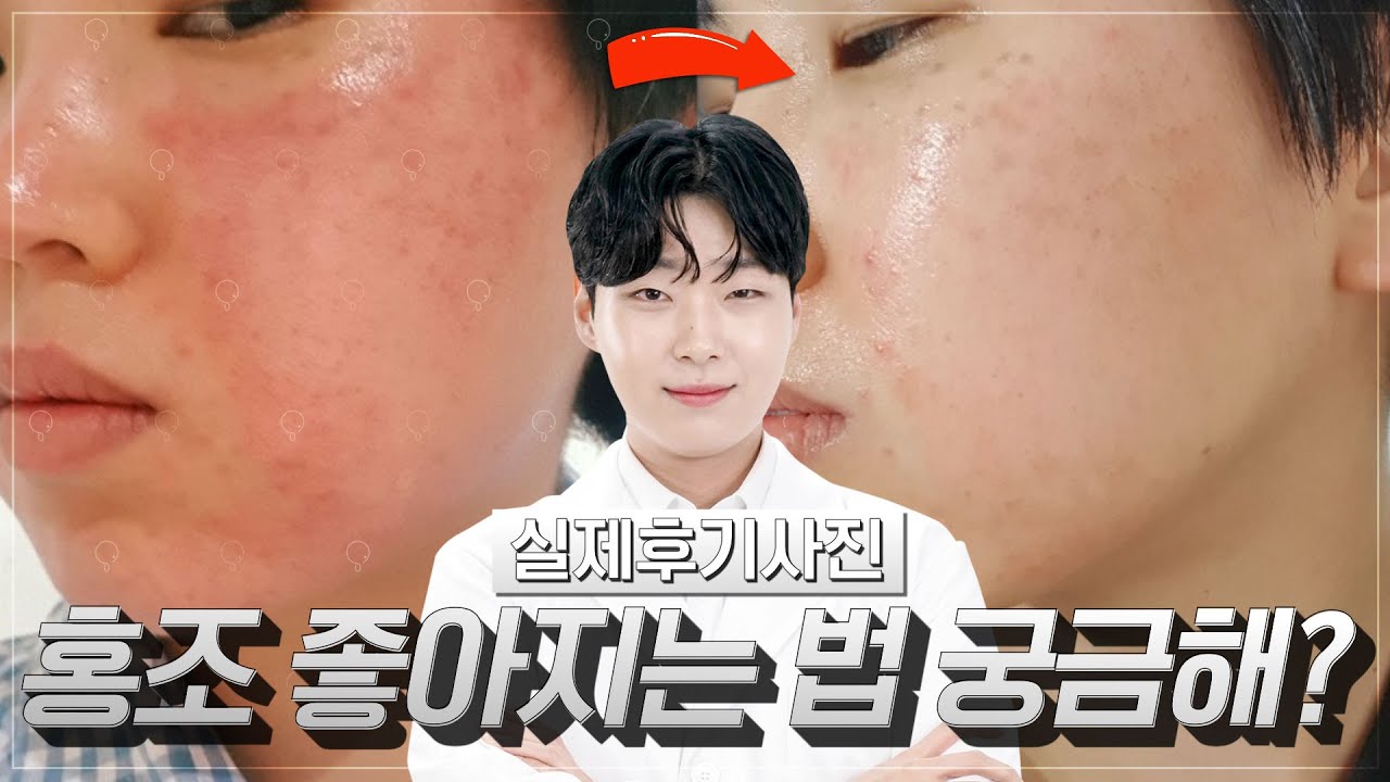 안면홍조,홍반,예민피부 무조건 봐야합니다!! l 홍조 100% 없애는 방법✨