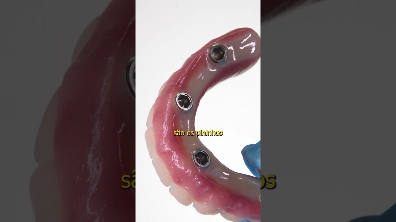 O que &eacute; Protocolo ALL on 4? - Implace Implantes