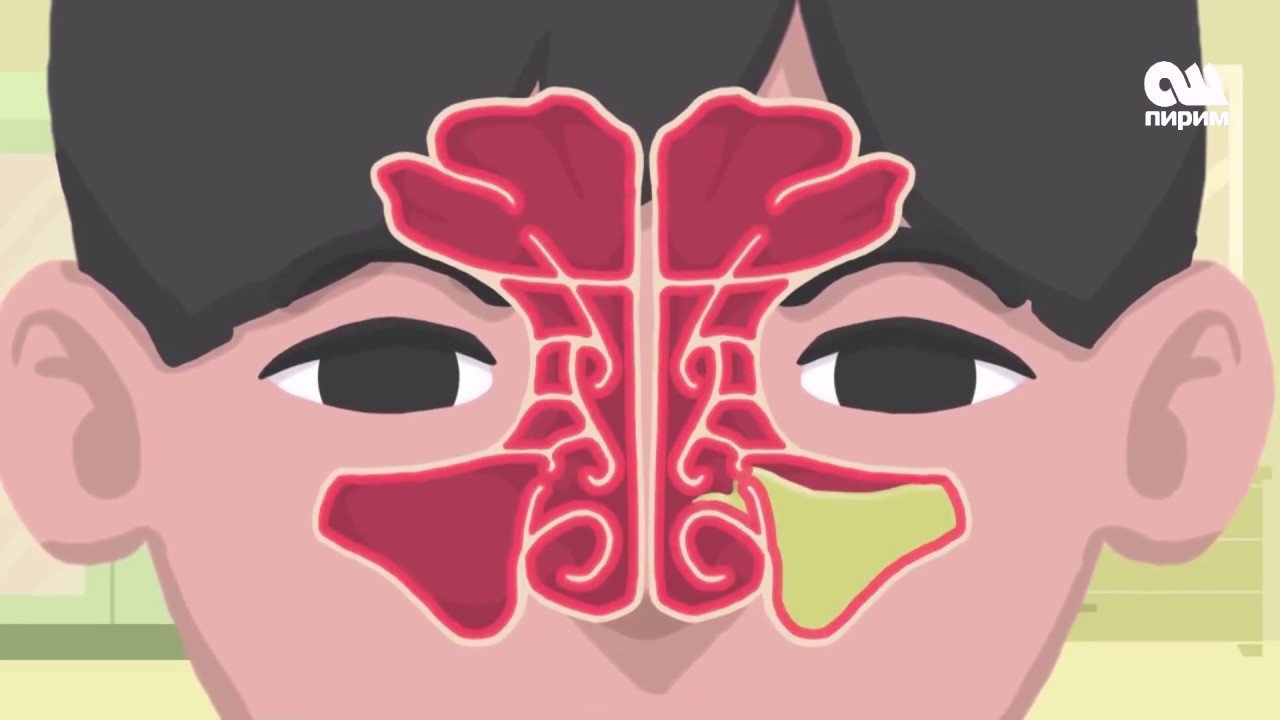 Гайморит оорусунун кантип алдын алабыз #денсоолук