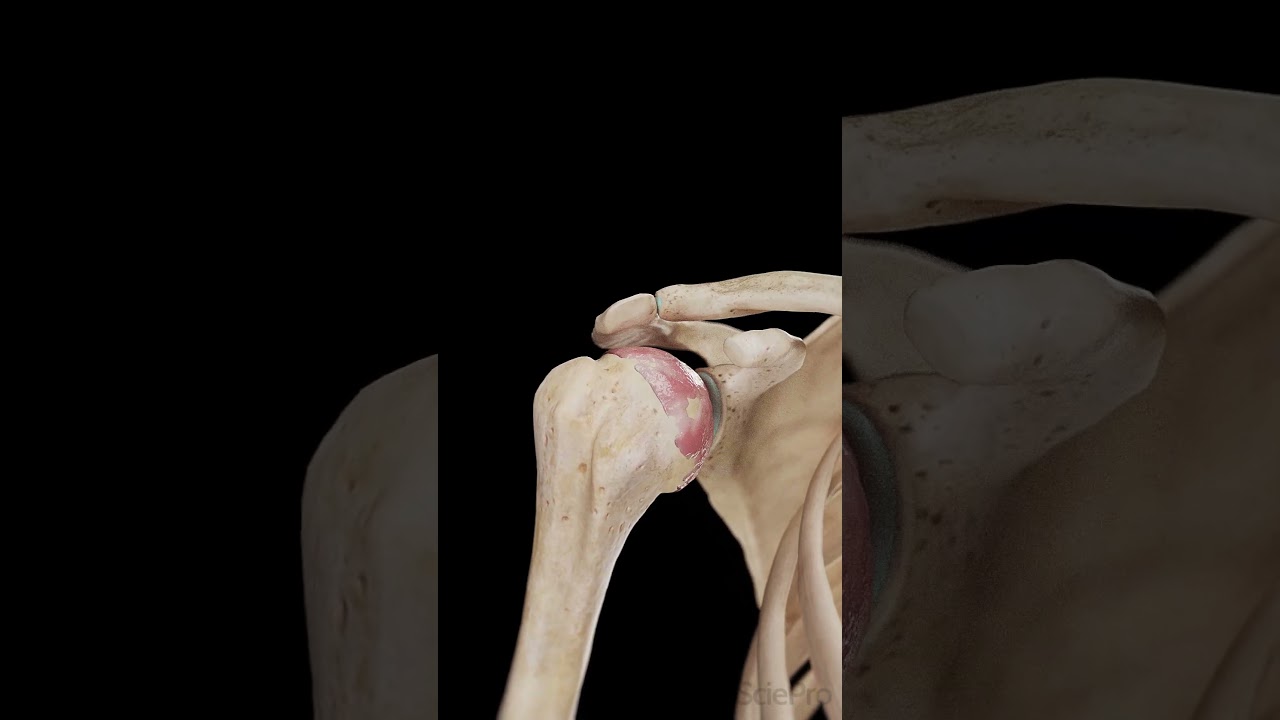 💪 Shoulder Arthritis: Understanding Joint Wear and Tear 💪