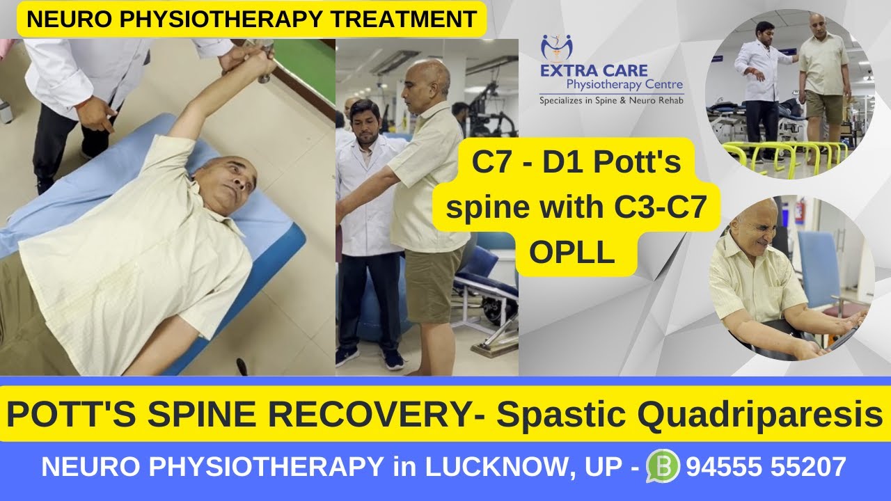 Pott's Spine Physiotherapy Rehab | Best Exercises for Pott's Spine | TB of Spine | Extra Care Lko