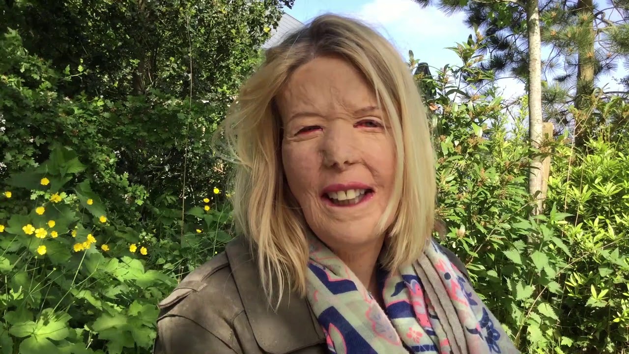 Marjorie on FIRE: vlog over LEVEN met BRANDWONDEN