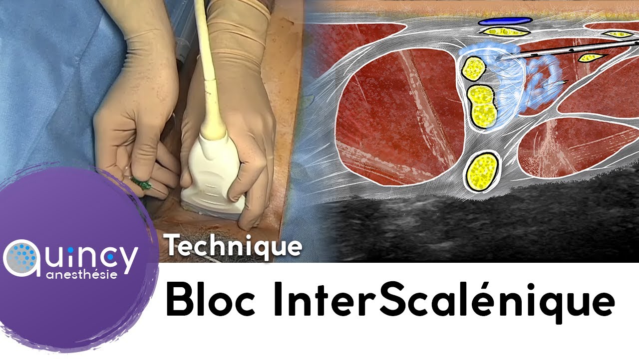 Le Bloc InterScalénique