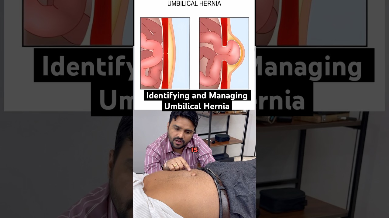 Identifying and Managing Umbilical Hernia #ytshort #feed #trend #feedshort