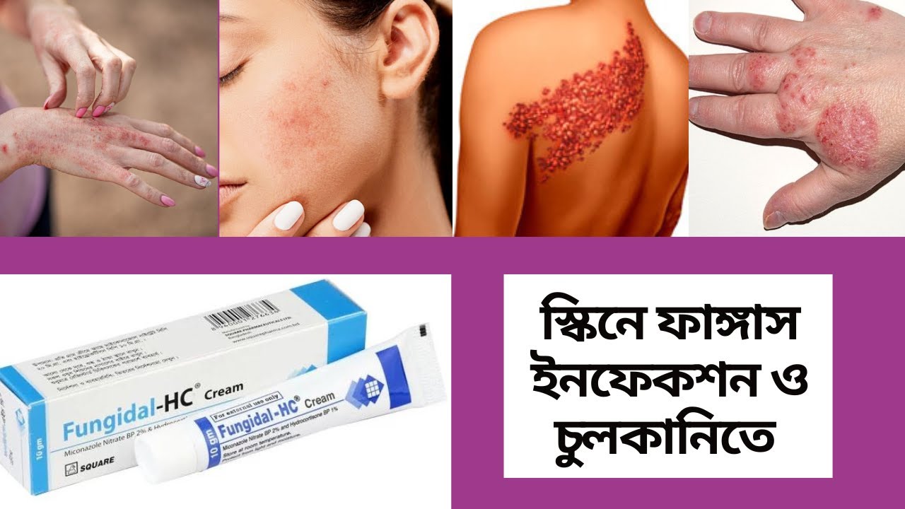 Fungidal-HC Cream বাংলায় সম্পূর্ণ মেডিসিনের বিবরণ || Med Unlimited