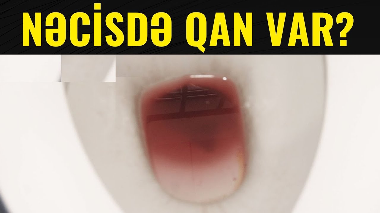 Nəcisdə qan vasa, bu videonu sona qədər  izlə