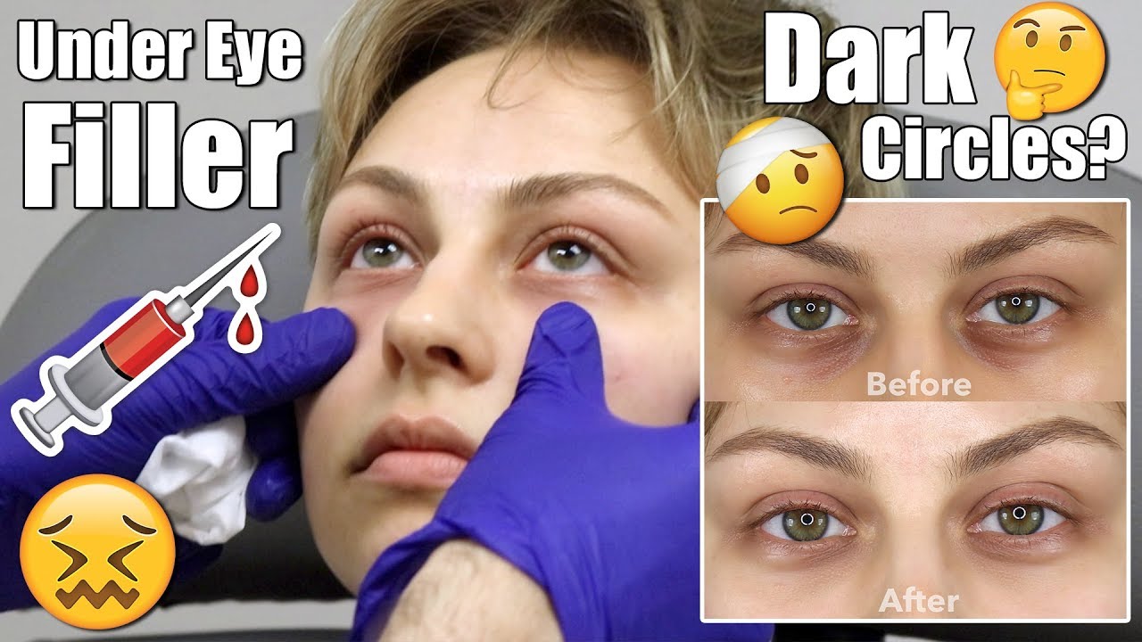 Under Eye Filler Injection for DARK CIRCLES | Alexandra Anele