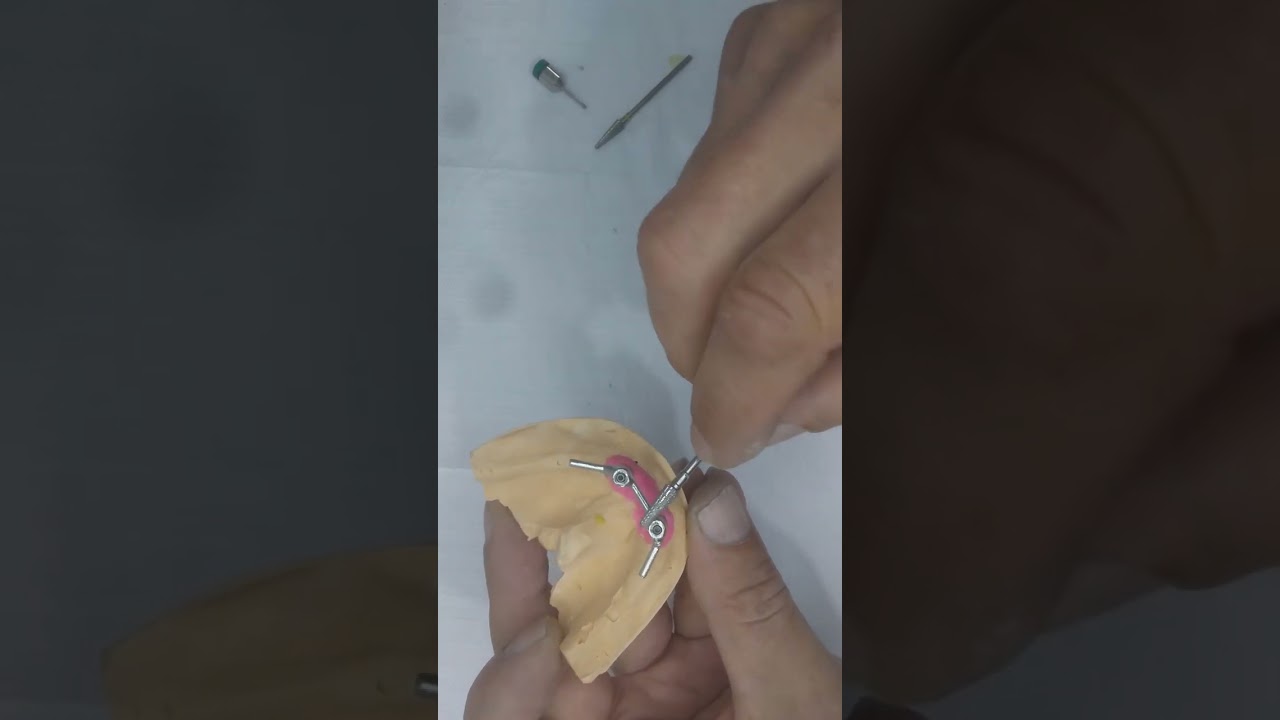 Barra de Overdenture Fundida