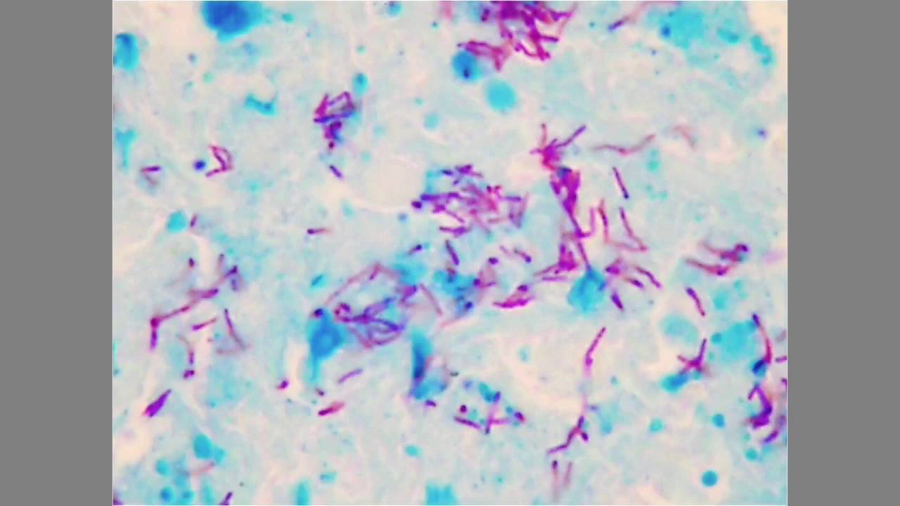 Tratamiento antifímico (de la tuberculosis)
