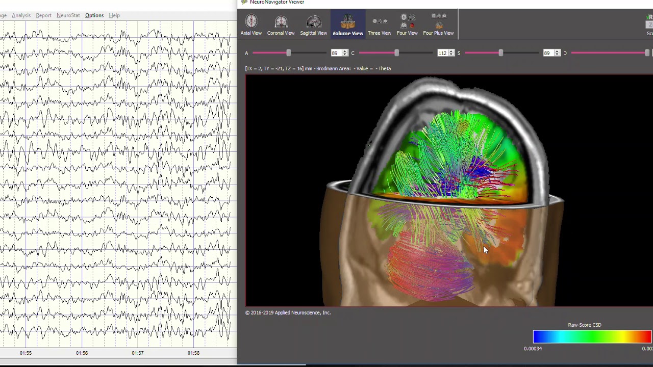 NeuroNavigator and EEG in Real-Time