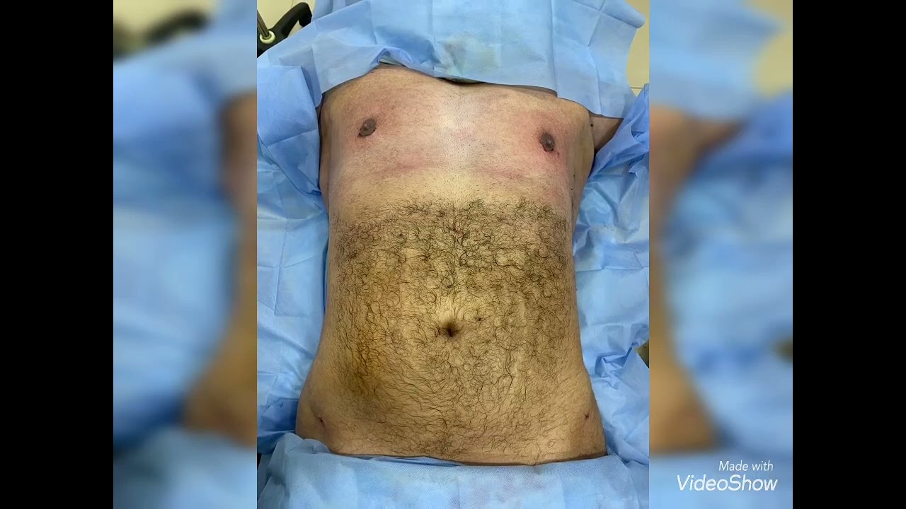 قبل وبعد ٢٤ ساعه شفط دهون الصدر والجوانب واسفل الضهر مع د محمد الهيتمى