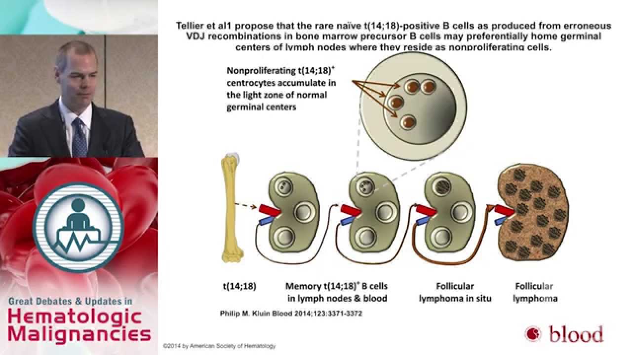 Debate: A Case of Stage IV Follicular Lymphoma - R-CHOP or B-R