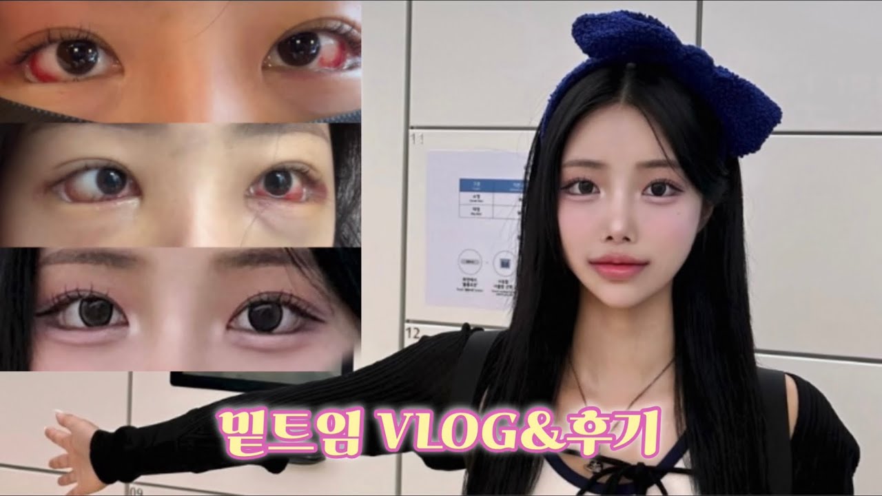 VLOG 밑트임 수술 붓기 과정 브이로그+후기